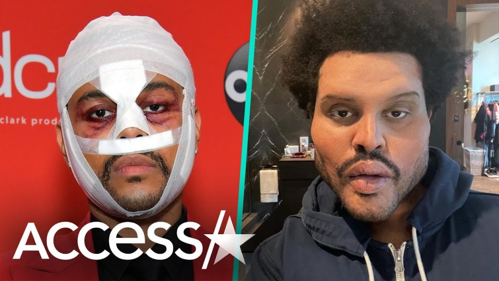 The Weeknd šokirao zavojima na licu i objasnio zašto! 1 maxresdefault