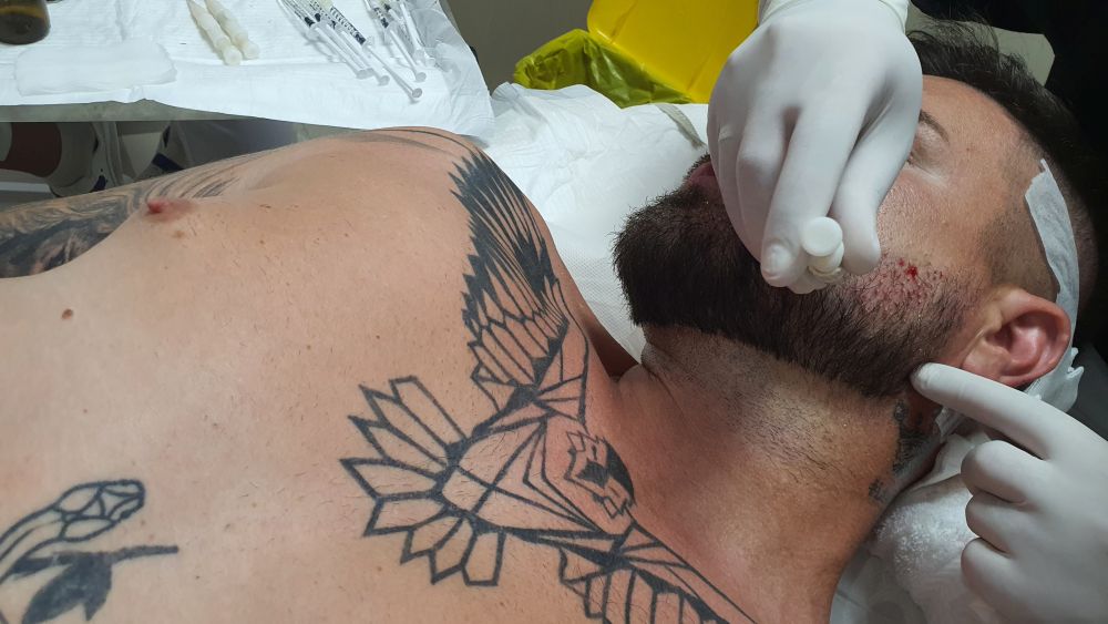 transplantacija kose na bradu MC Stojan AHT metoda