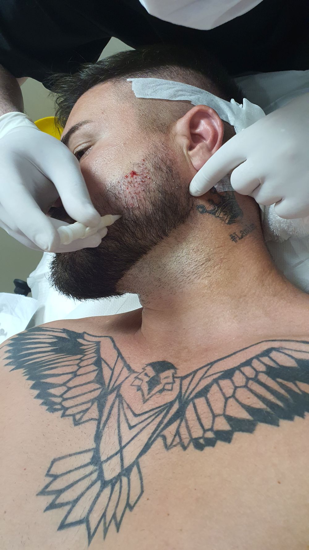 transplantacija kose na bradu MC Stojan